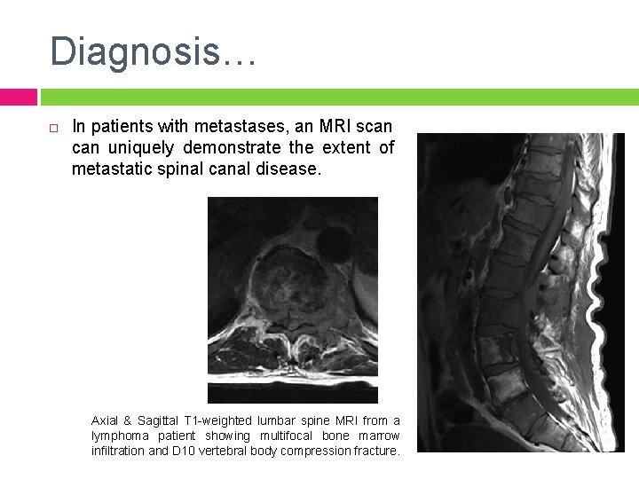 Diagnosis… In patients with metastases, an MRI scan uniquely demonstrate the extent of metastatic