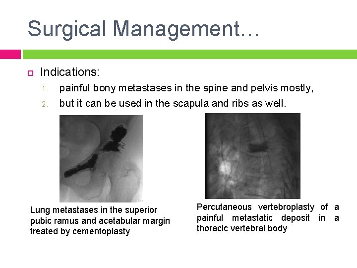 Surgical Management… Indications: 1. 2. painful bony metastases in the spine and pelvis mostly,