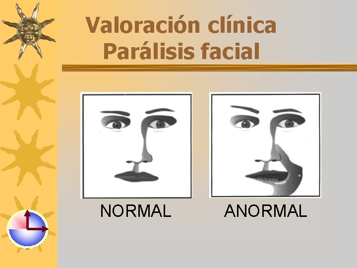 Valoración clínica Parálisis facial NORMAL ANORMAL 