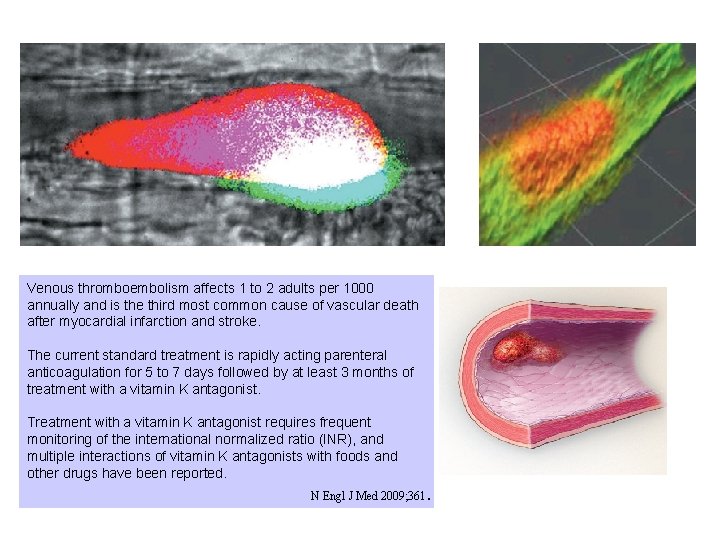 Venous thromboembolism affects 1 to 2 adults per 1000 annually and is the third