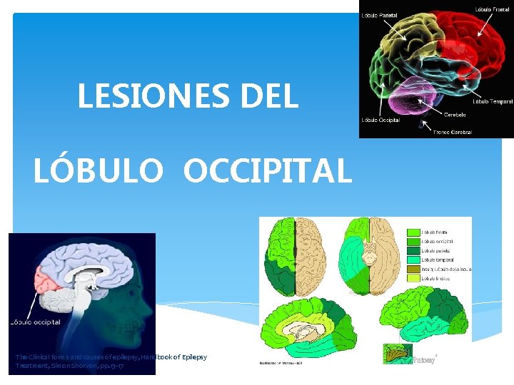 LESIONES DEL LÓBULO OCCIPITAL The Clinical forms and causes of epilepsy, Handbook of Epilepsy