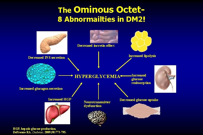 The Ominous Octet 8 Abnormailties in DM 2! Decreased incretin effect Increased lipolysis Decreased