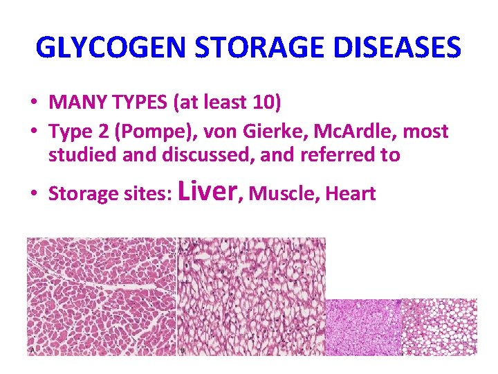 GLYCOGEN STORAGE DISEASES • MANY TYPES (at least 10) • Type 2 (Pompe), von