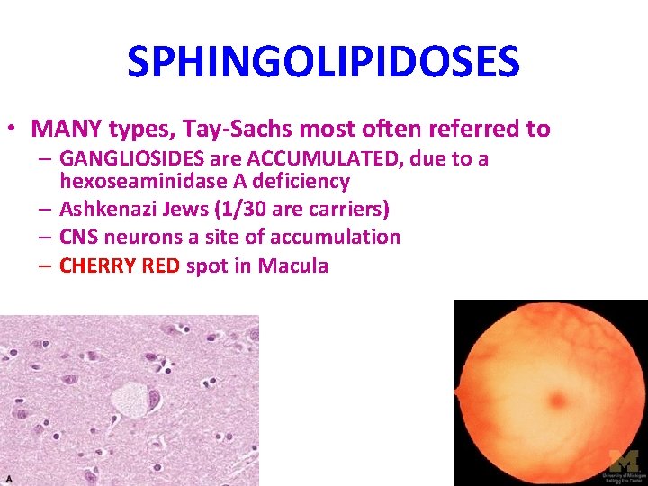 SPHINGOLIPIDOSES • MANY types, Tay-Sachs most often referred to – GANGLIOSIDES are ACCUMULATED, due