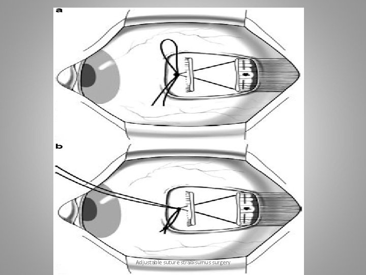 Adjustable suture strabisumus surgery 