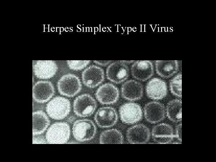 Herpes Simplex Type II Virus 