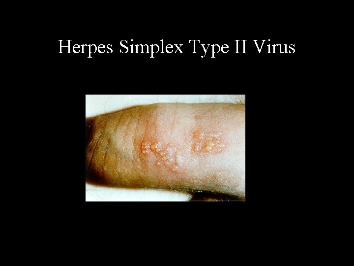 Herpes Simplex Type II Virus 