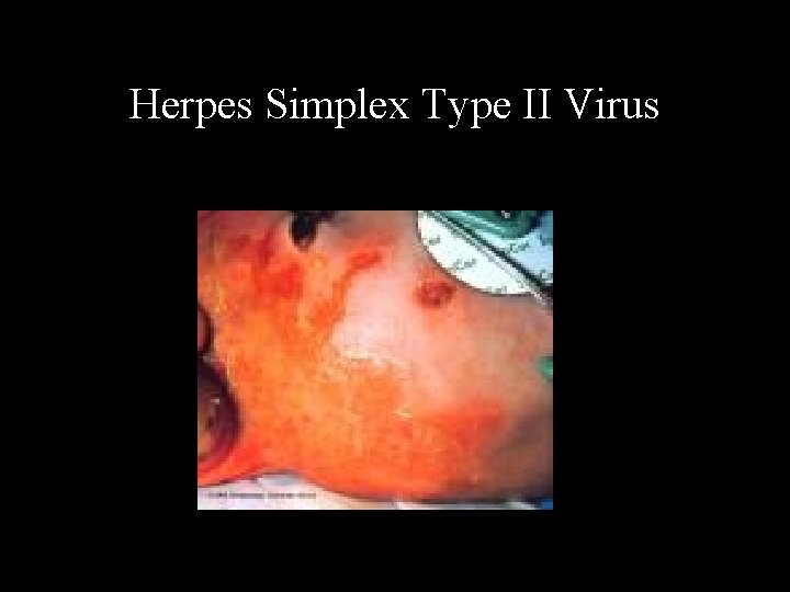 Herpes Simplex Type II Virus 