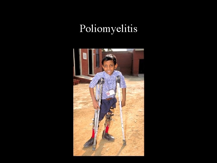 Poliomyelitis 