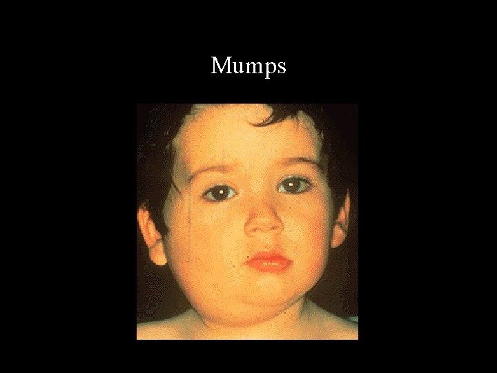 Mumps 