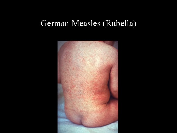 German Measles (Rubella) 