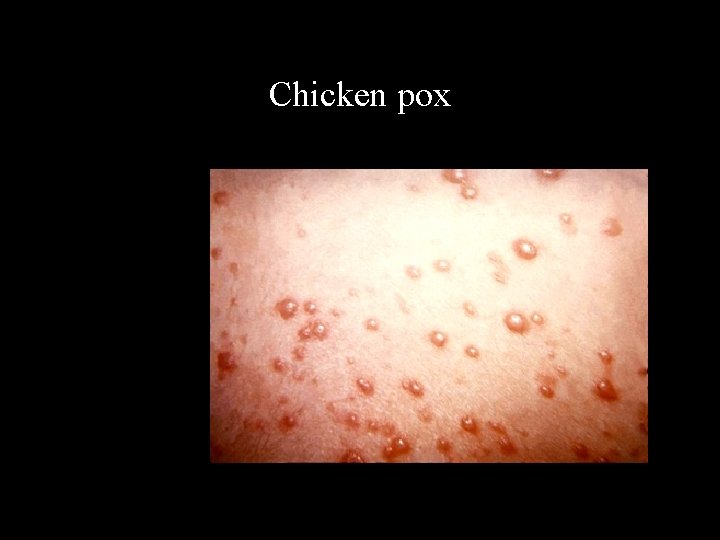 Chicken pox 