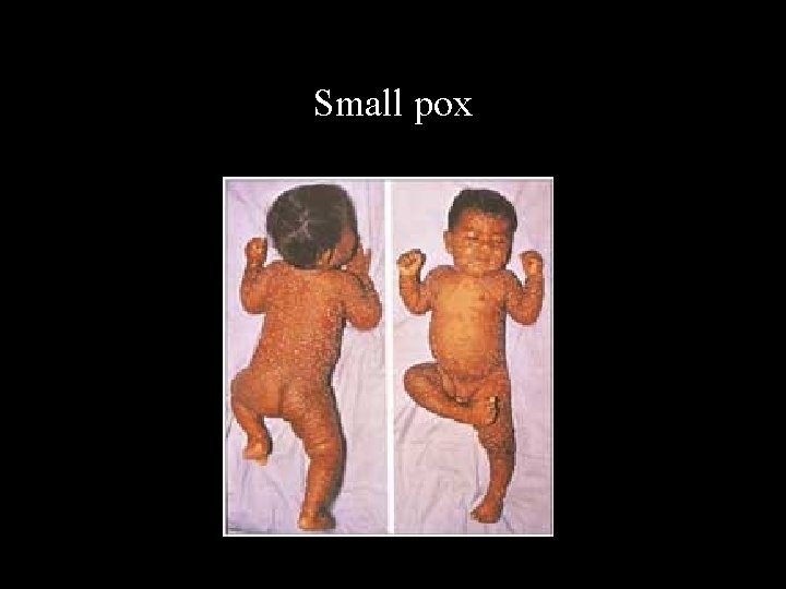 Small pox 