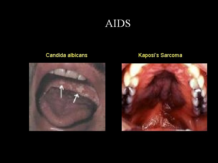 AIDS Candida albicans Kaposi’s Sarcoma 