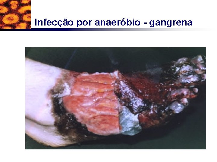 Infecção por anaeróbio - gangrena 
