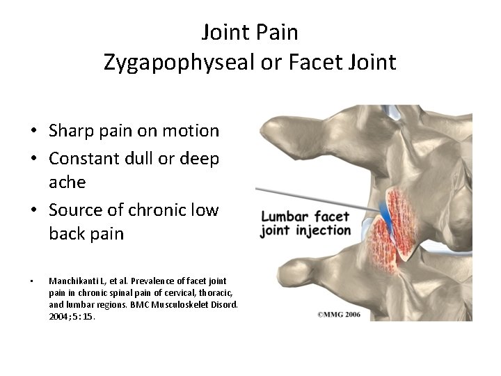 Joint Pain Zygapophyseal or Facet Joint • Sharp pain on motion • Constant dull