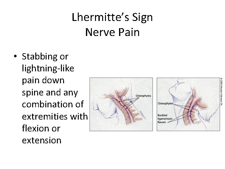 Lhermitte’s Sign Nerve Pain • Stabbing or lightning-like pain down spine and any combination