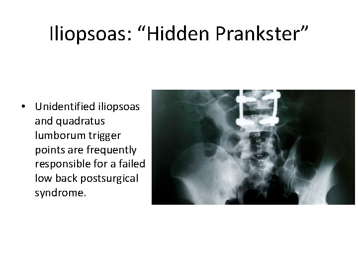 Iliopsoas: “Hidden Prankster” • Unidentified iliopsoas and quadratus lumborum trigger points are frequently responsible