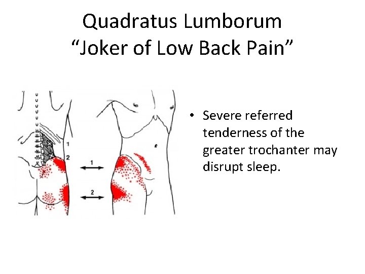 Quadratus Lumborum “Joker of Low Back Pain” • Severe referred tenderness of the greater