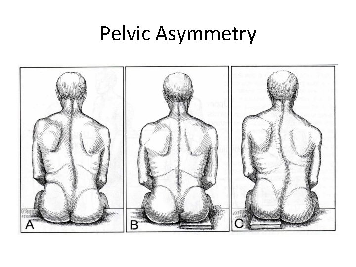 Pelvic Asymmetry 