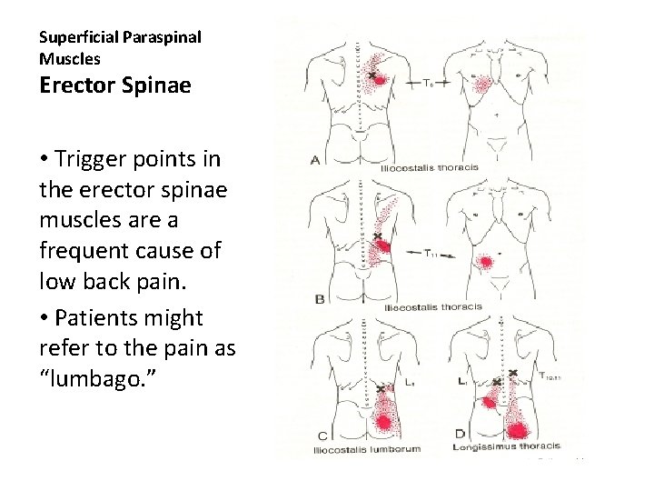 Superficial Paraspinal Muscles Erector Spinae • Trigger points in the erector spinae muscles are