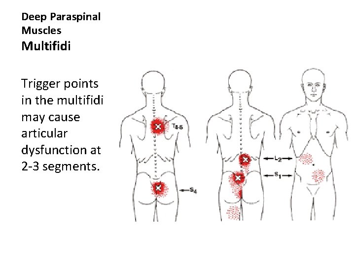 Deep Paraspinal Muscles Multifidi Trigger points in the multifidi may cause articular dysfunction at