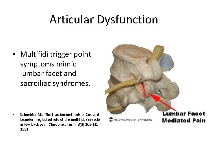 Articular Dysfunction • Multifidi trigger point symptoms mimic lumbar facet and sacroiliac syndromes. •