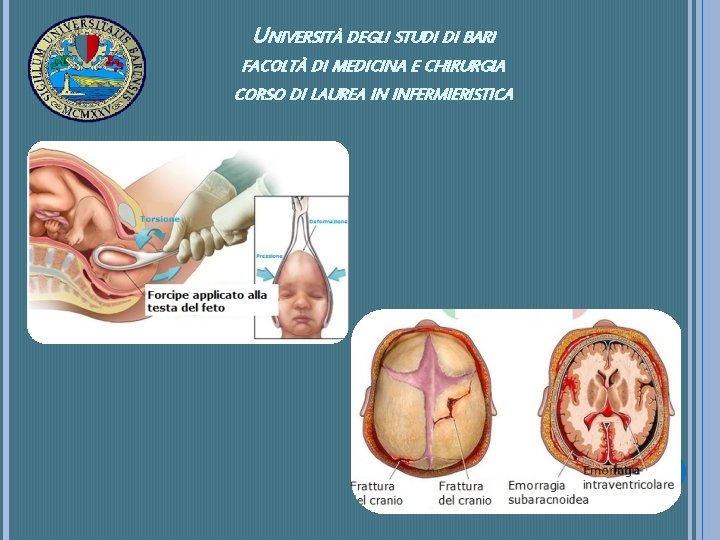 UNIVERSITÀ DEGLI STUDI DI BARI FACOLTÀ DI MEDICINA E CHIRURGIA CORSO DI LAUREA IN