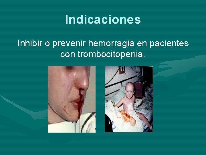 Indicaciones Inhibir o prevenir hemorragia en pacientes con trombocitopenia. 