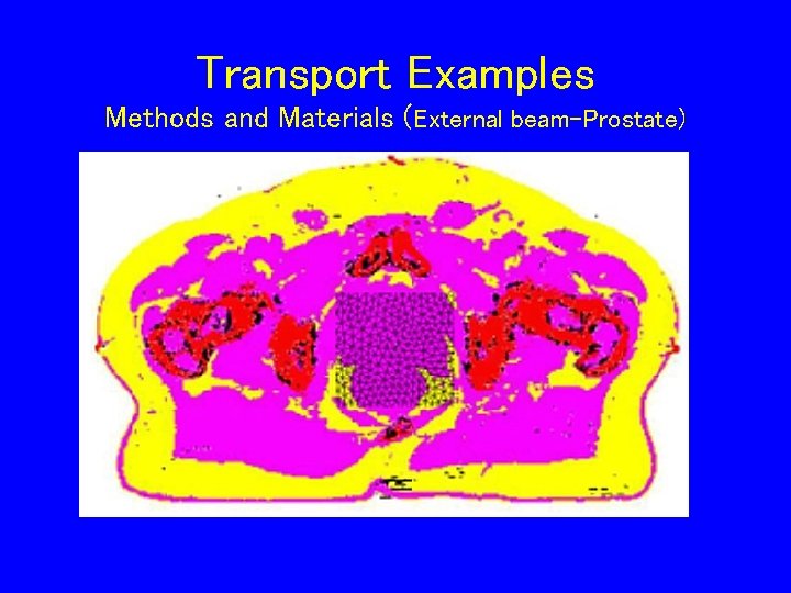 Transport Examples Methods and Materials (External beam-Prostate) 