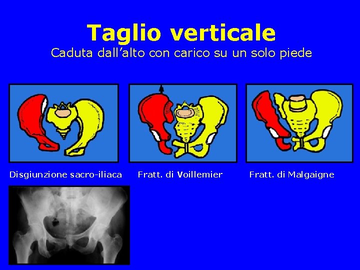 Taglio verticale Caduta dall’alto con carico su un solo piede Disgiunzione sacro-iliaca Fratt. di