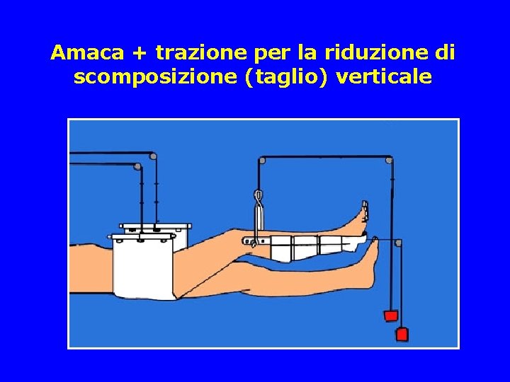 Amaca + trazione per la riduzione di scomposizione (taglio) verticale 