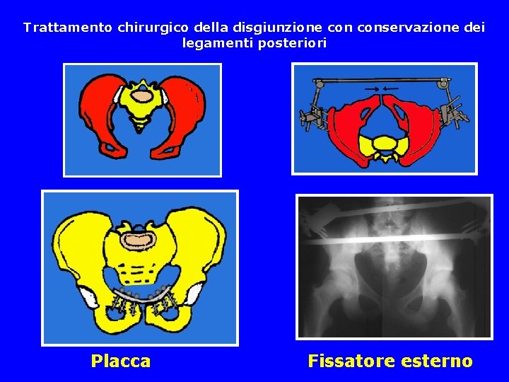 Trattamento chirurgico della disgiunzione conservazione dei legamenti posteriori Placca Fissatore esterno 