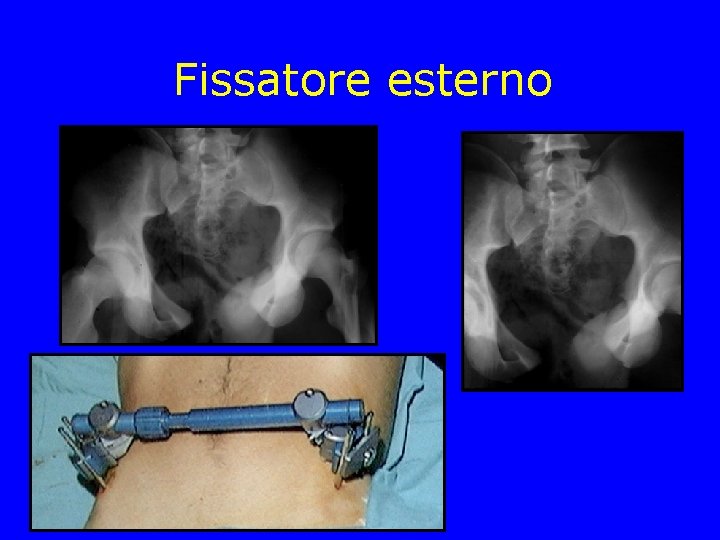 Fissatore esterno 