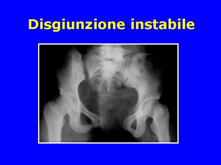 Disgiunzione instabile 