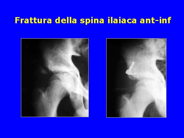 Frattura della spina ilaiaca ant-inf 