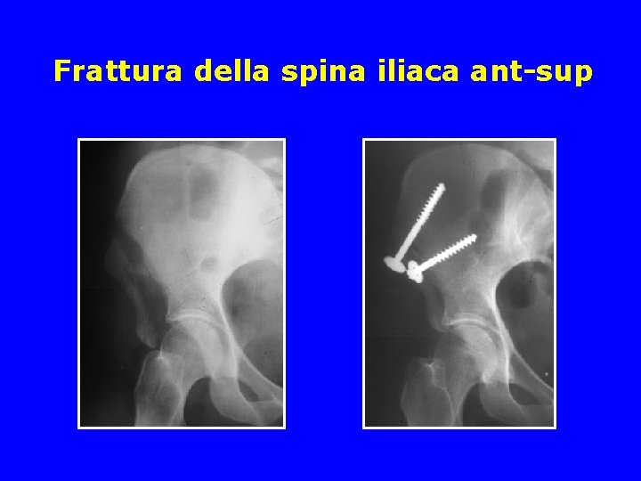 FRATTURE DI BACINO Classificazione delle fratture di bacino