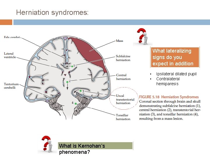 Herniation syndromes: • • What is Kernohan’s phenomena? What lateralizing signs do you expect