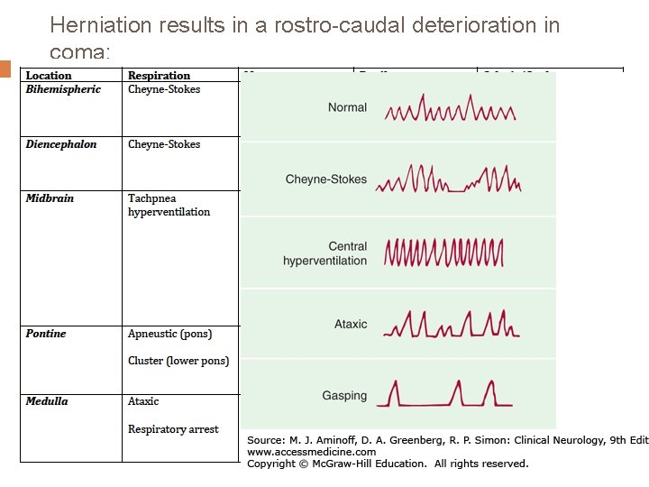 Herniation results in a rostro-caudal deterioration in coma: 