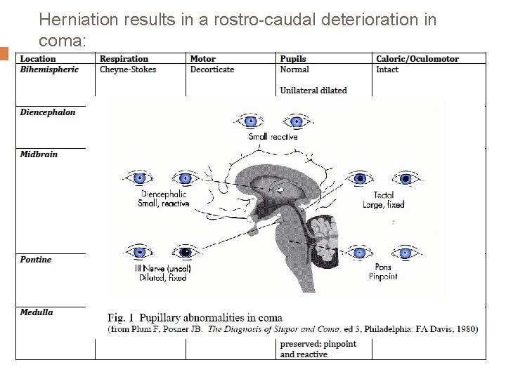 Herniation results in a rostro-caudal deterioration in coma: 