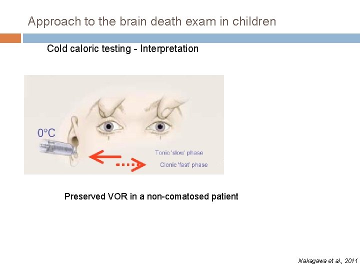 Approach to the brain death exam in children Cold caloric testing - Interpretation Preserved