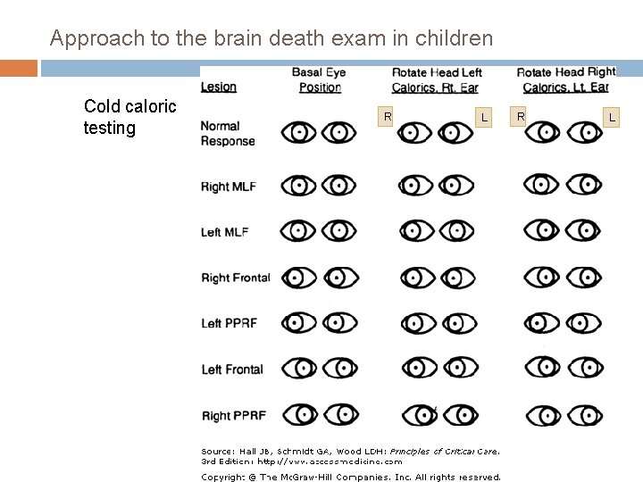 Approach to the brain death exam in children Cold caloric testing R L 