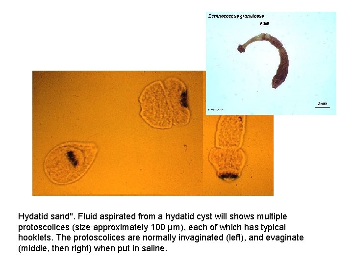 Hydatid sand". Fluid aspirated from a hydatid cyst will shows multiple protoscolices (size approximately