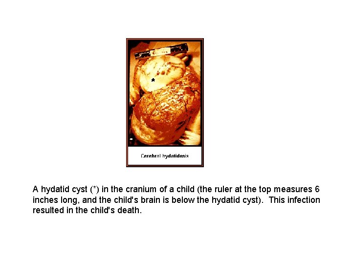 A hydatid cyst (*) in the cranium of a child (the ruler at the