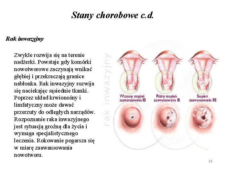 Stany chorobowe c. d. Rak inwazyjny Zwykle rozwija się na terenie nadżerki. Powstaje gdy