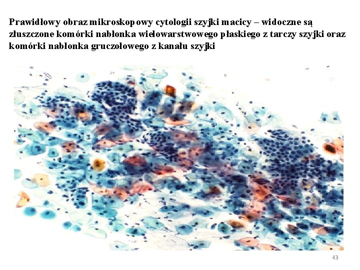 Prawidłowy obraz mikroskopowy cytologii szyjki macicy – widoczne są złuszczone komórki nabłonka wielowarstwowego płaskiego Prawidłowy obraz mikroskopowy cytologii szyjki macicy – widoczne są złuszczone komórki nabłonka wielowarstwowego płaskiego