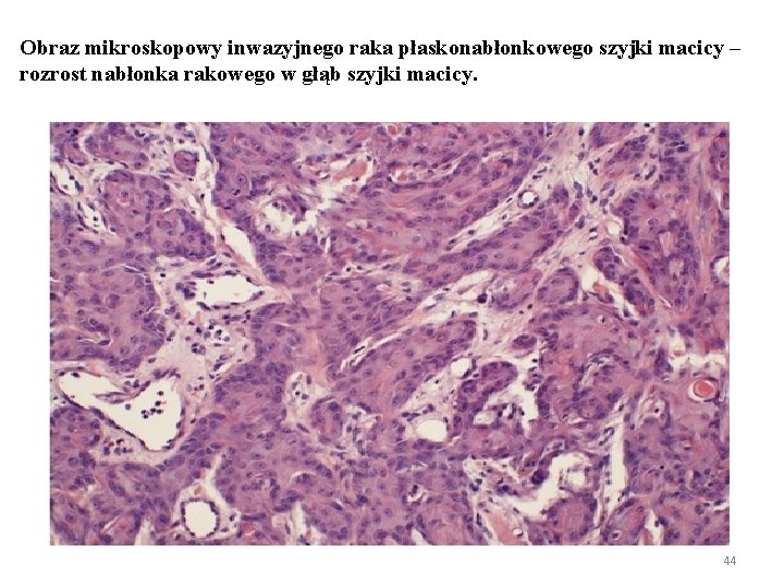 Obraz mikroskopowy inwazyjnego raka płaskonabłonkowego szyjki macicy – rozrost nabłonka rakowego w głąb szyjki