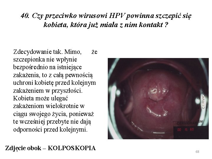 40. Czy przeciwko wirusowi HPV powinna szczepić się kobieta, która już miała z nim