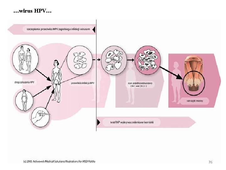 …wirus HPV… 76 