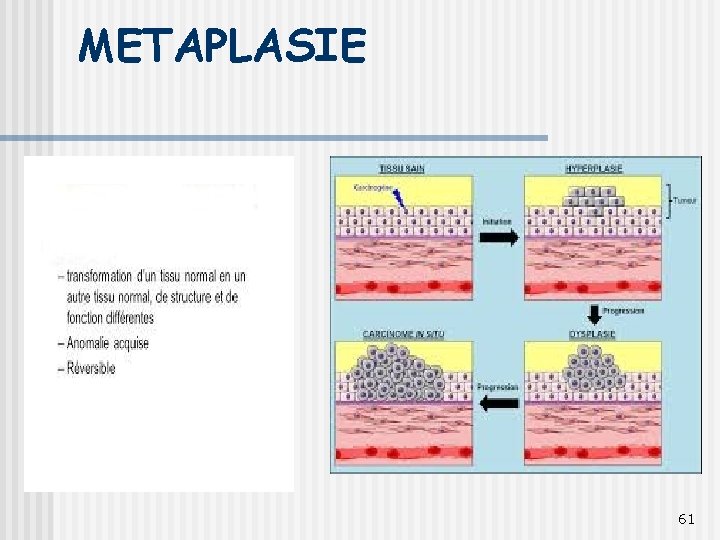METAPLASIE 61 